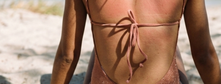 close up photo a woman wearing a swimsuit with a mild sunburn